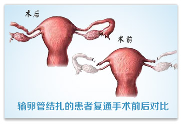 北京高龄助孕产子医院排名_输卵管结扎后再次怀孕的要求是什么？